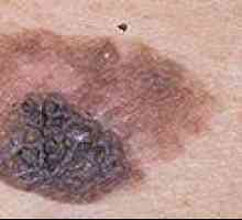 Kako ugotoviti prisotnost melanoma in njeno zdravljenje