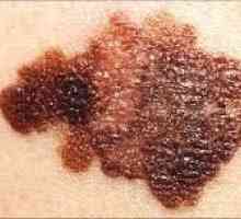 Kako določiti površino melanoma in preprečiti njen razvoj