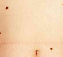 Kako je maligni melanom debla in kako jo zdraviti