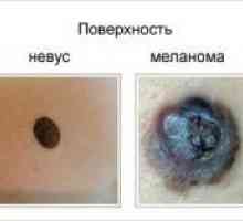Kako razlikovati melanoma od NEVI