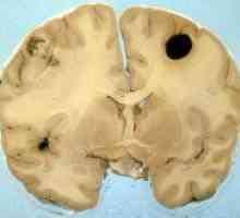 Kako prepoznati in zdraviti melanom možgane