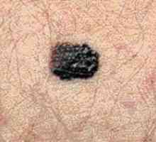 Kako prepoznate melanoma: simptomi in metode diagnostike