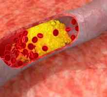 Kako za zniževanje holesterola v (stopnjo holesterola za ženske in moške) v krvi