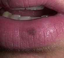 Kako diagnosticirati in zdraviti melanoma na ustnici