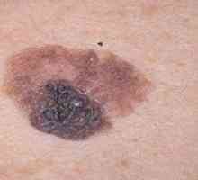 Kaj vzroki prispevajo k videzu melanoma