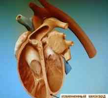 Kardiomiopatija