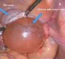 Corpus luteum ciste med nosečnostjo, vzroki, zdravljenje