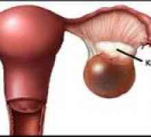 Cystoma (desno, levo) ovarijski - vzroki, zdravljenje