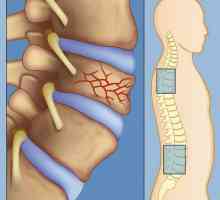 Zlom stiskanje ledvene hrbtenice: sorta in zdravljenje