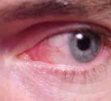 Konjunktivitis ali rdeče oči: simptomi, zdravljenje
