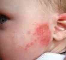 Rdeče lise na koži otroka - vzroki, zdravljenje