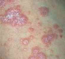 Lichen planus: simptomih in vzrokih tumorjev