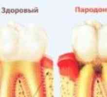Zdravljenje parodontalne bolezni na domu