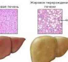 Zdravljenje steatozo jeter