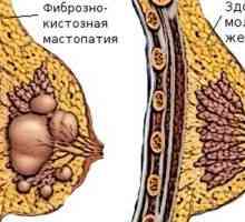 Cistična bolezni dojk - vzrok, simptomi in zdravljenje