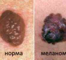 Metode, ki se uporabljajo za zdravljenje melanoma