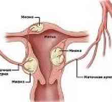 Fibroidi med nosečnostjo, vzroki, zdravljenje