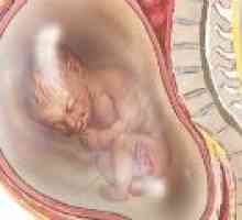 Polyhydramnios med nosečnostjo, vzrokov, posledic
