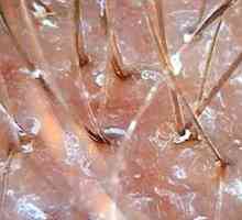 Najučinkovitejše metode zdravljenja seboroični dermatitis lasišča