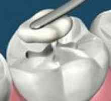 Nenavadne materiale za tesnila bo boj proti zobni gnilobi