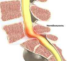 Nestabilnost simptomov vratne hrbtenice in zdravljenje