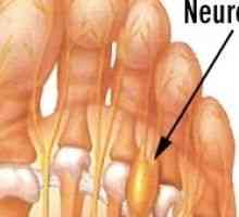 Mortonov neurom (boleče stopalo) - vzroki, simptomi in zdravljenje