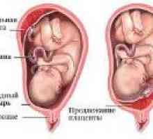 Nizka Placentacija med nosečnostjo, kaj je to?
