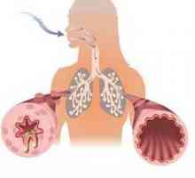 Obstrukcija dihalnih poti