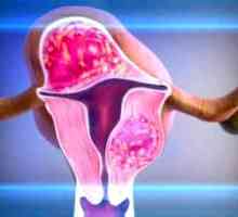 Kirurška odstranitev maternice fibroids