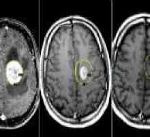 Brain Tumor - vzroki, simptomi, zdravljenje
