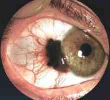 Diagnoza in zdravljenje očesne melanoma