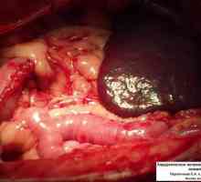 Značilnosti pooperativnem obdobju po odstranitvi debelega črevesa in tumorjev