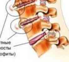 Osteofiti iz vratne hrbtenice: vzroki, zdravljenje