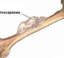 Osteosarkom (osteogeni sarkom) - vzroki, simptomi, diagnosticiranje in zdravljenje