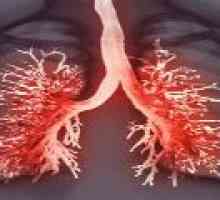 Plevritis pljuča - simptomi in zdravljenje z plevritisa