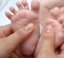 Ploska stopala v otroke, vzroki, zdravljenje