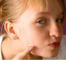 Zakaj dobim in kako odstraniti akne na licih