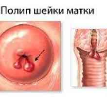 Polip v maternici med nosečnostjo, vzroki, zdravljenje
