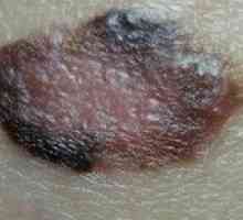 Površina melanom: simptomi, vzroki, zdravljenje