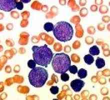 Povečana limfocitov v krvi odraslega, otroka, razlog
