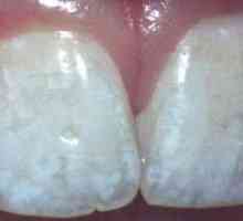 Vzroki za bele lise na zobeh
