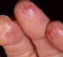 Vzroki in zdravljenje razpok na rokah in prstih