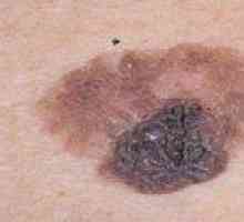 Značilnosti in posebnosti zdravljenje melanoma faze 3