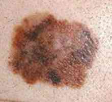 Napovedi pričakovane življenjske dobe melanoma kože