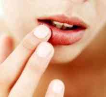 Mozolj na ustnice: kako se znebiti od vzrokov