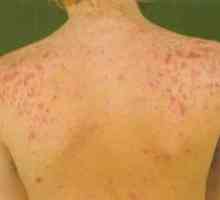 Mozolji na ramenih: vzrokov in zdravljenja