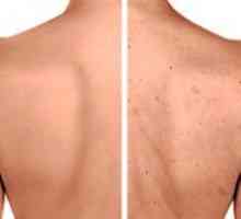 Akne na hrbtu: Vzroki in zdravljenje