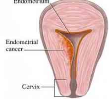 Rak endometrija