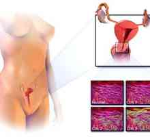 Rak materničnega vratu: znaki in simptomi