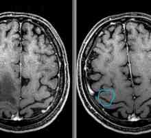 Zgodnja stopnja možganskega tumorja